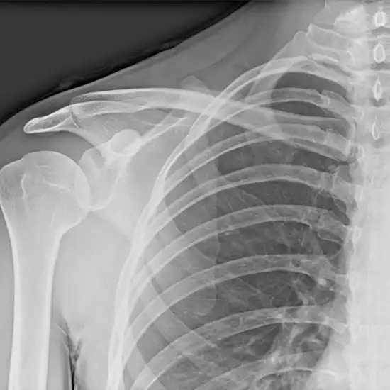 X-ray Right Scapula AP View